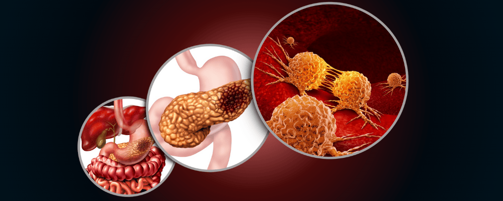 Pancreas Cancer Specialist in Surat - Adwaita Cancer Hospital